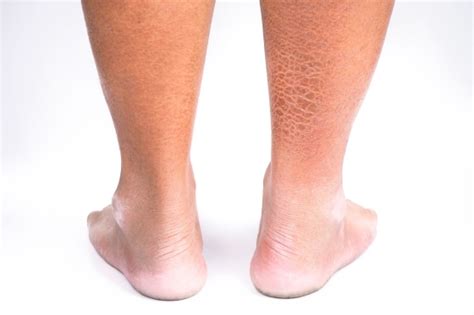 Este posibil să se trateze boala varicoasă a picioarelor cu ceapă indiană?